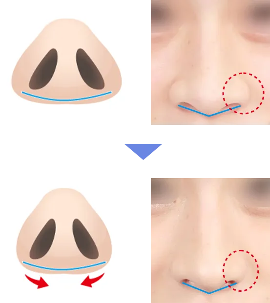切らない小鼻縮小