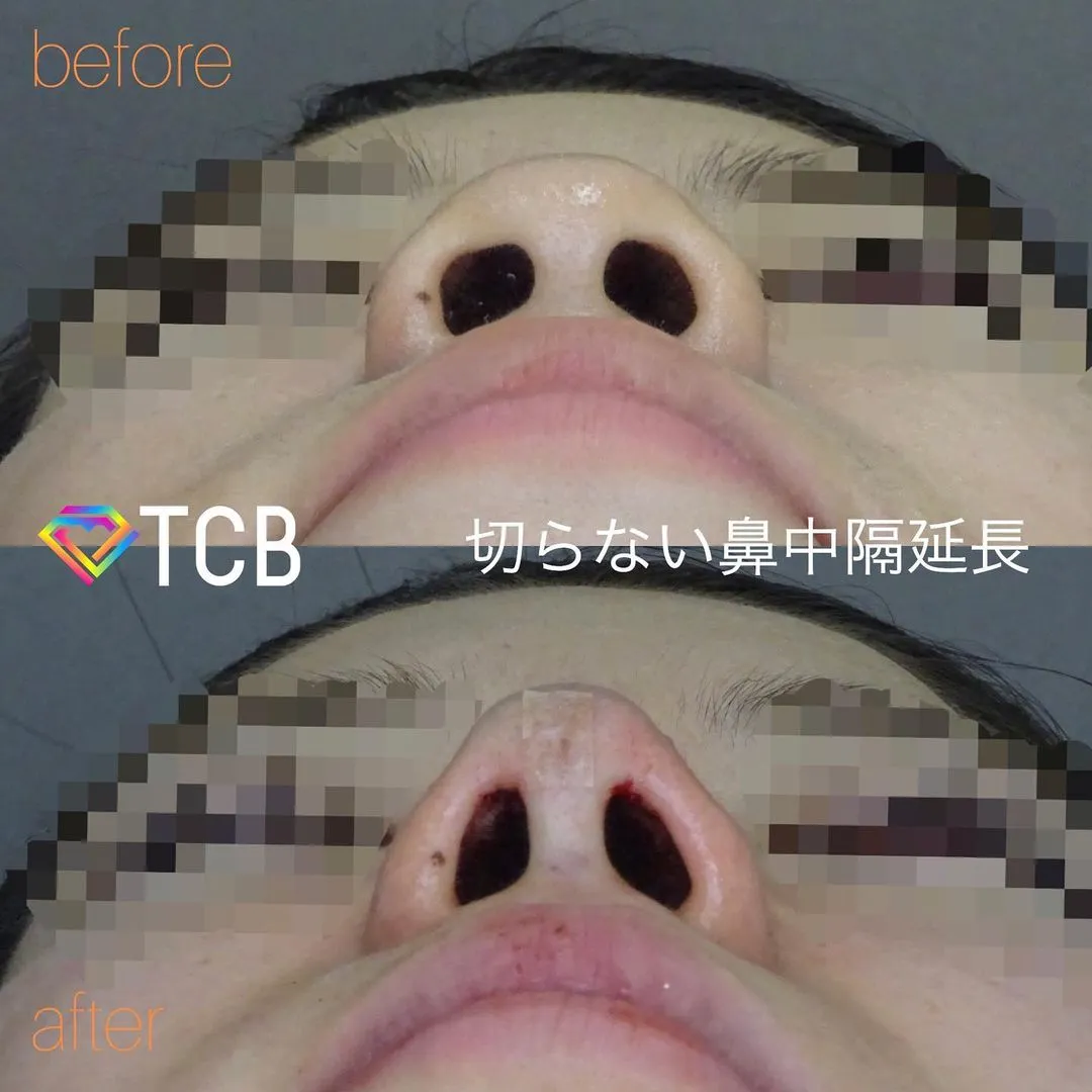 鼻の症例写真