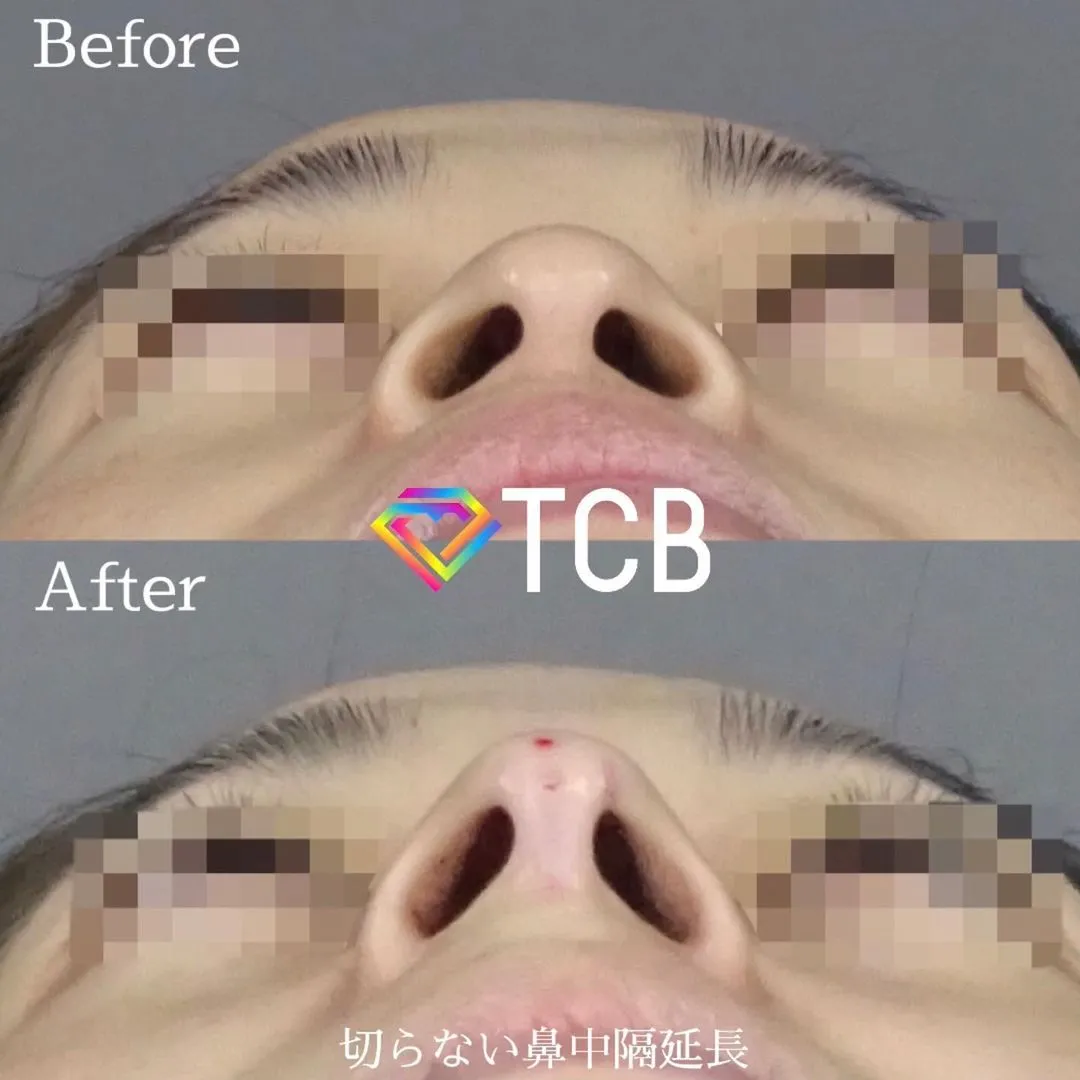 鼻の症例写真