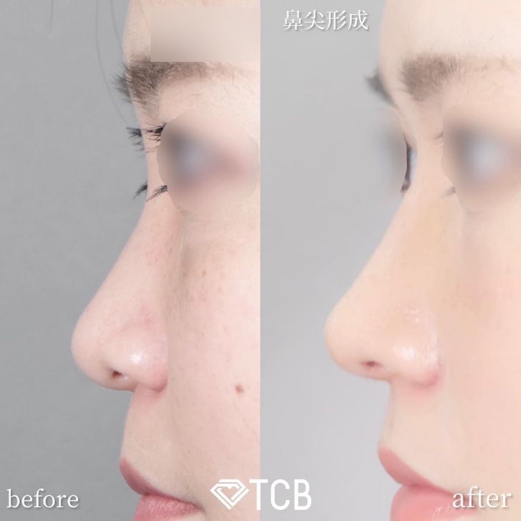 鼻尖形成+鼻中隔延長の症例写真