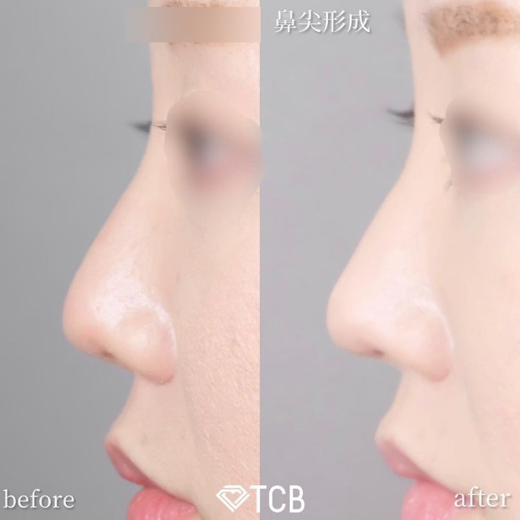 鼻尖形成+鼻中隔延長の症例写真
