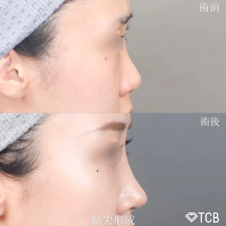 鼻の症例写真