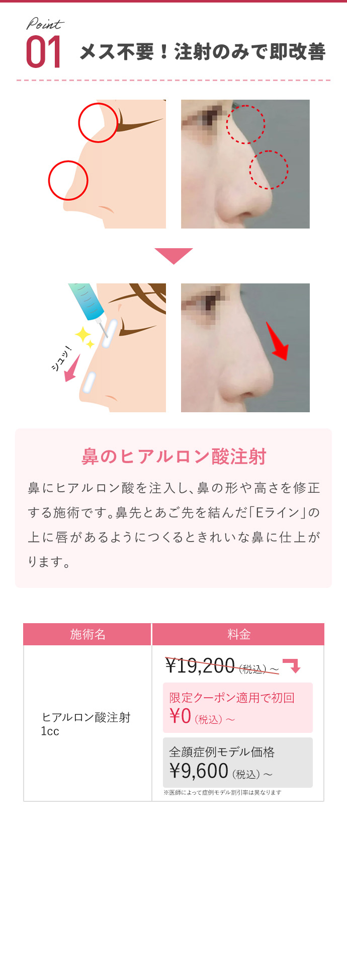 メス不要！注射のみで即改善