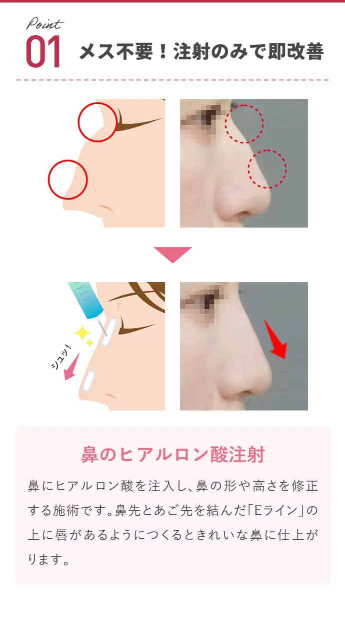 メス不要!注射のみで即改善