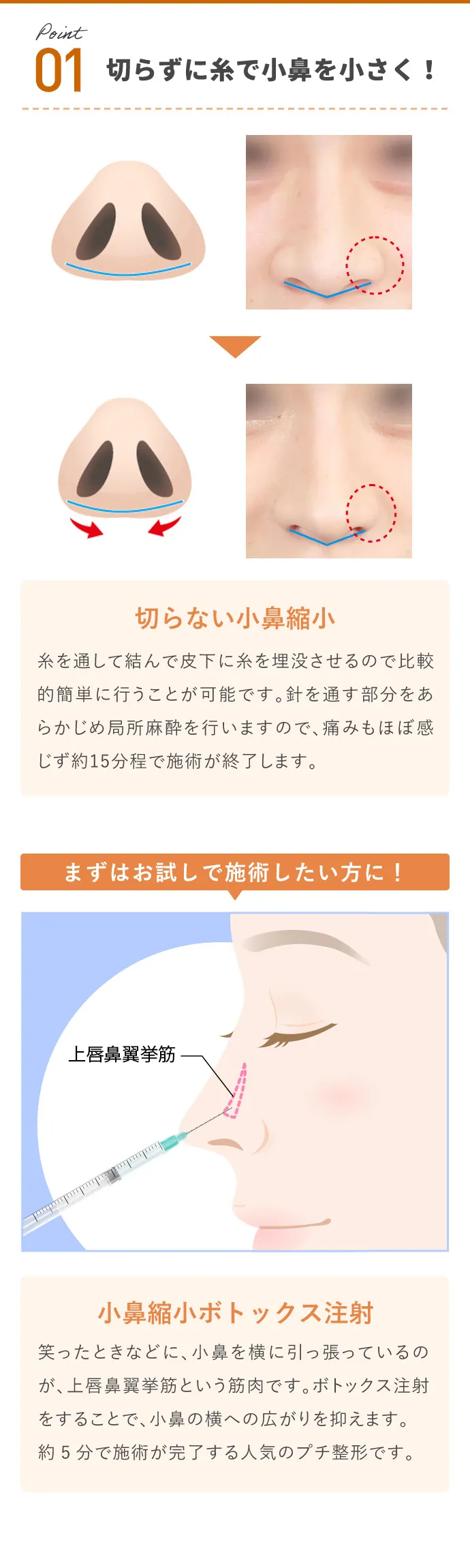 切らずに糸で小鼻を小さく!