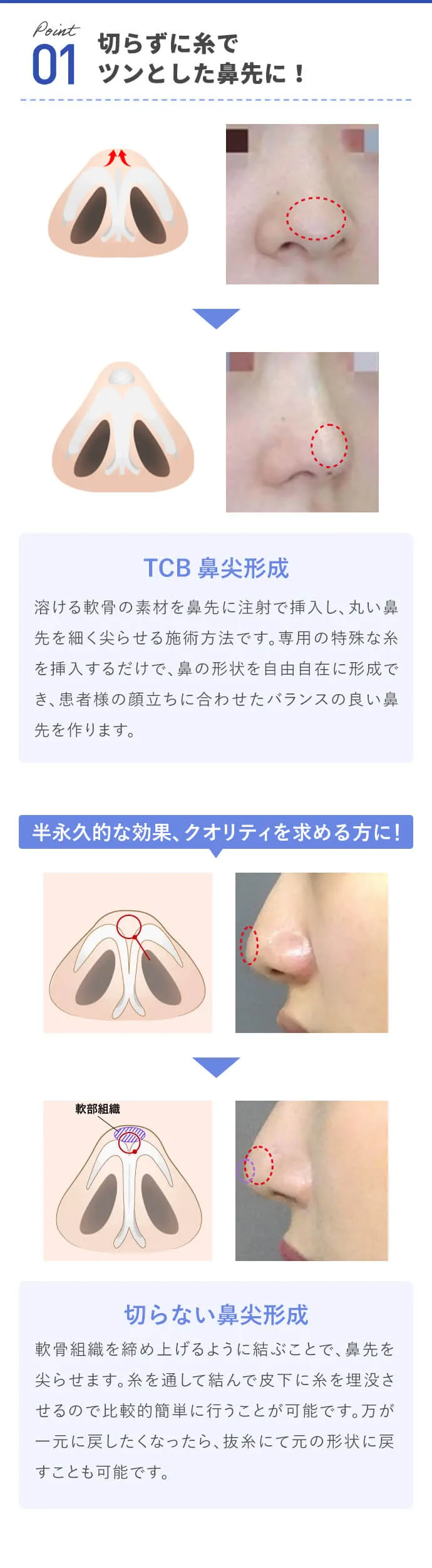 切らずに糸でツンとした鼻先に!