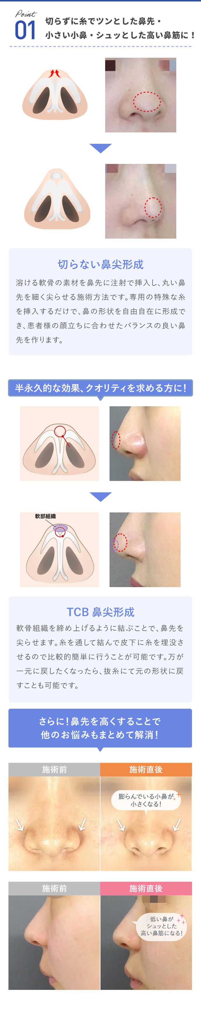 切らずに糸でツンとした鼻先に！