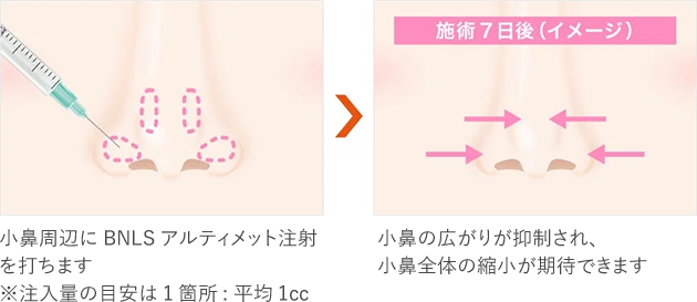 BNLSアルティメット注射・鼻への施術イメージ
