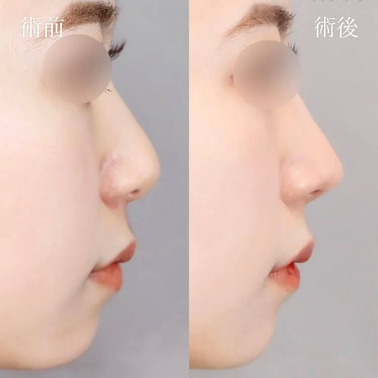 TCB鼻尖形成の症例写真