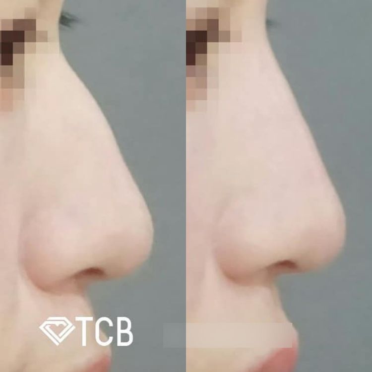 鼻のヒアルロン酸注射の症例写真