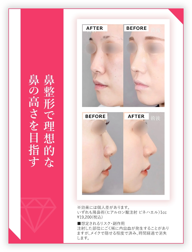 鼻整形で理想的な鼻の高さに