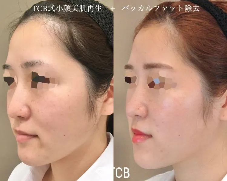 脂肪除去の症例写真
