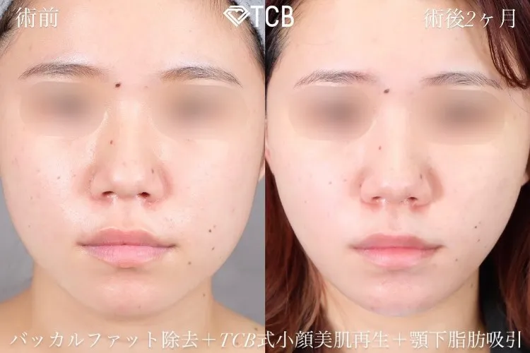 脂肪除去の症例写真