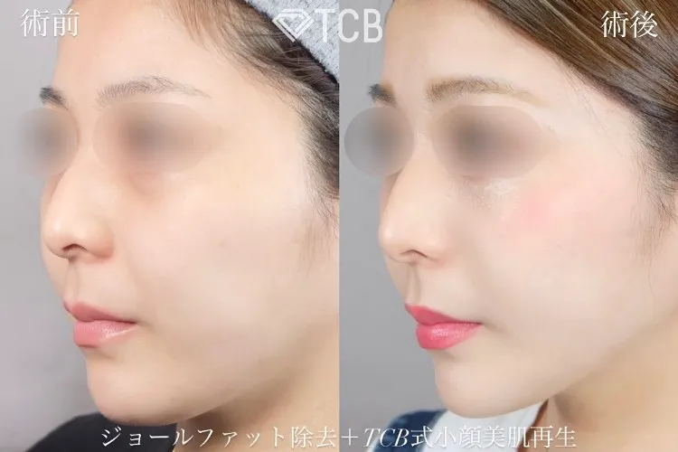 脂肪除去の症例写真