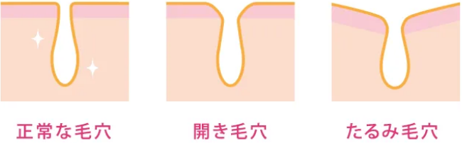 ダーマペン4の効果 正常な毛穴、開き毛穴、たるみ毛穴