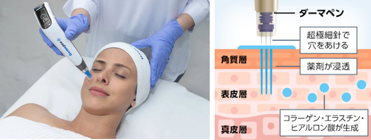 ダーマペンの説明