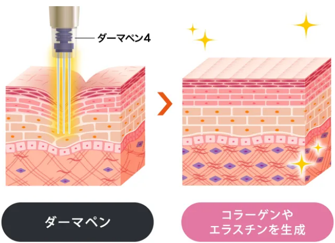 ダーマペン4の効果 コラーゲンやエラスチンを生成