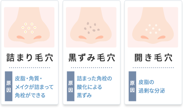 詰まり毛穴、黒ずみ毛穴、開き毛穴