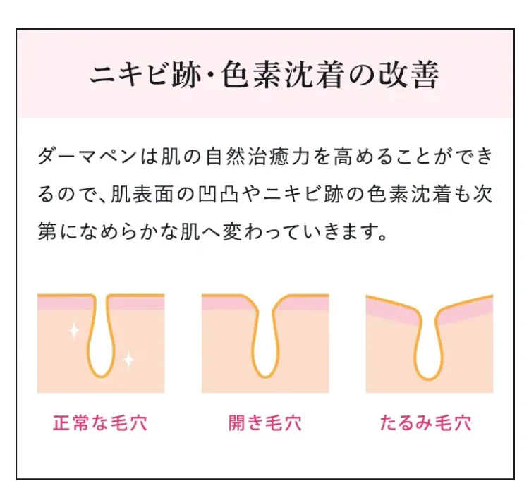 ダーマペン4の効果2