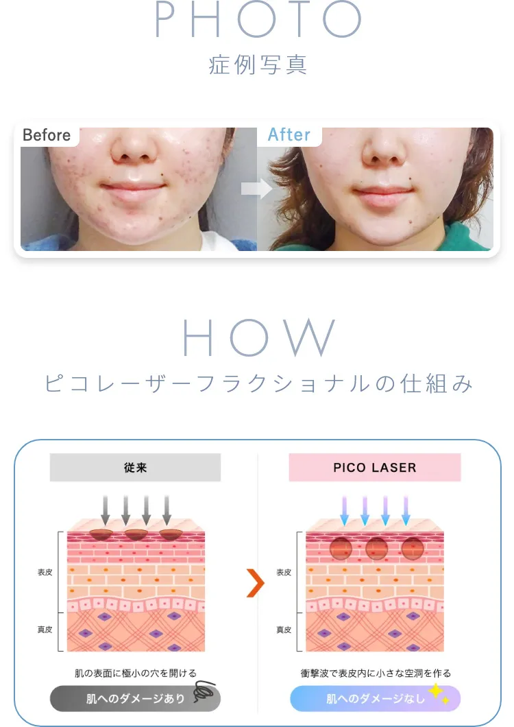症例写真 ピコレーザーフラクショナルの仕組み