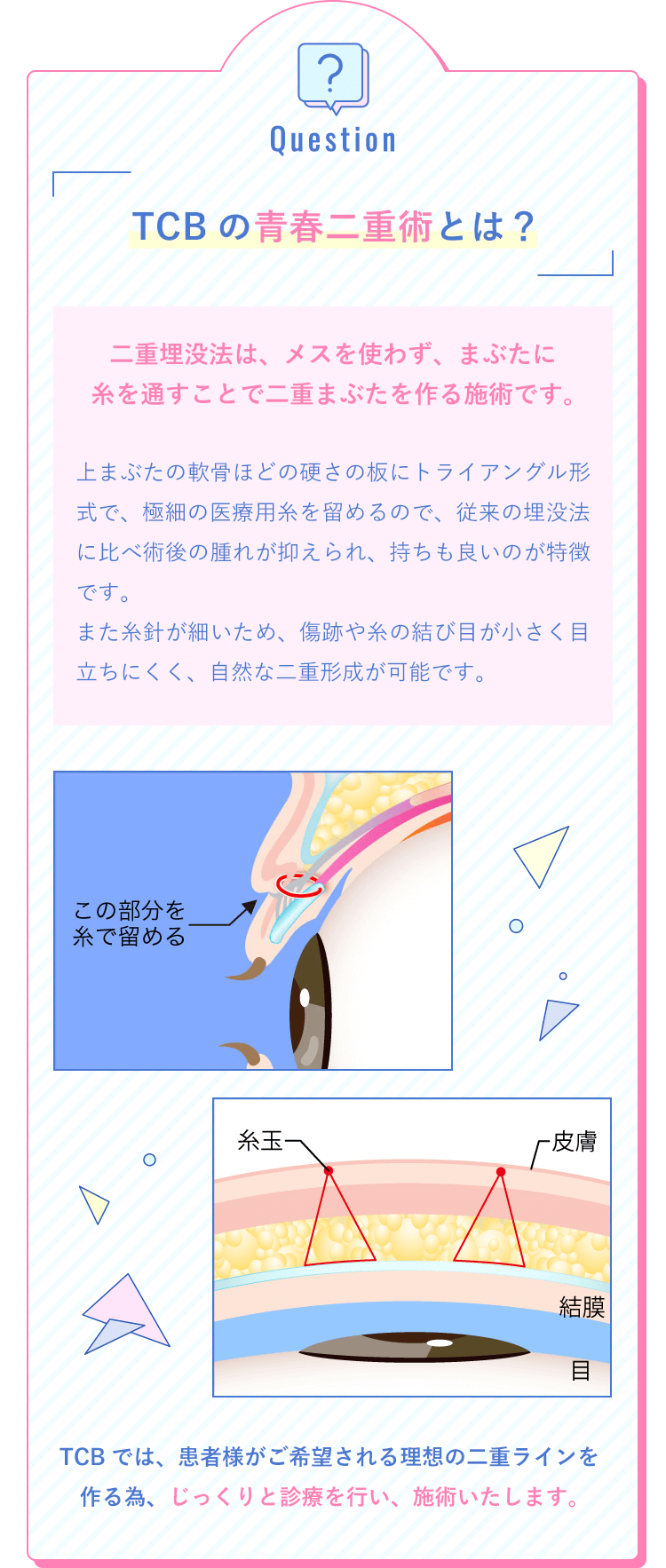 TCBの二重埋没法とは？