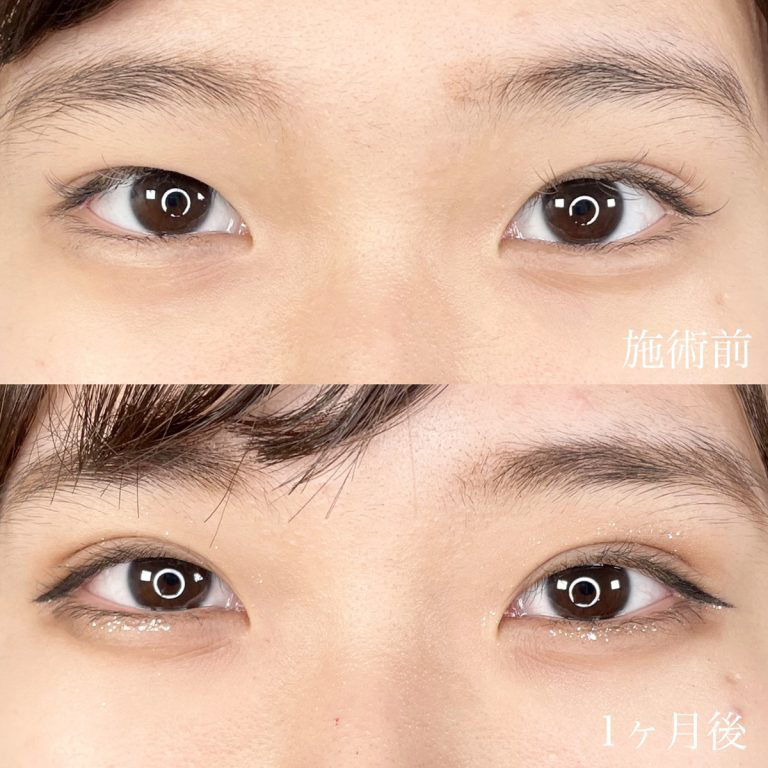 青春二重術の症例写真1