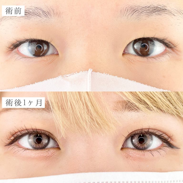 青春二重術の症例写真2