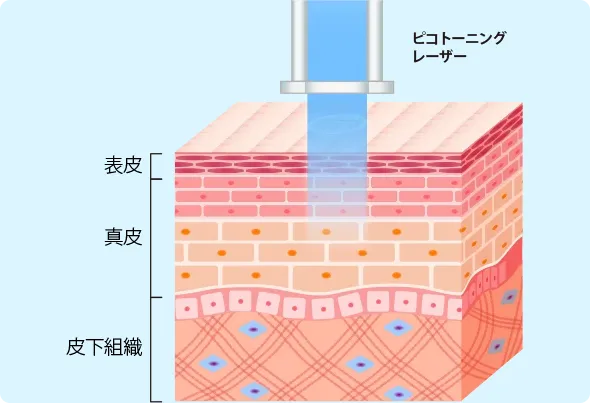 ピコレーザー(ピコトーニング)の図解