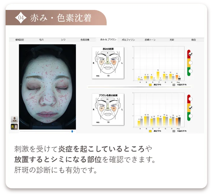 赤み・色素沈着