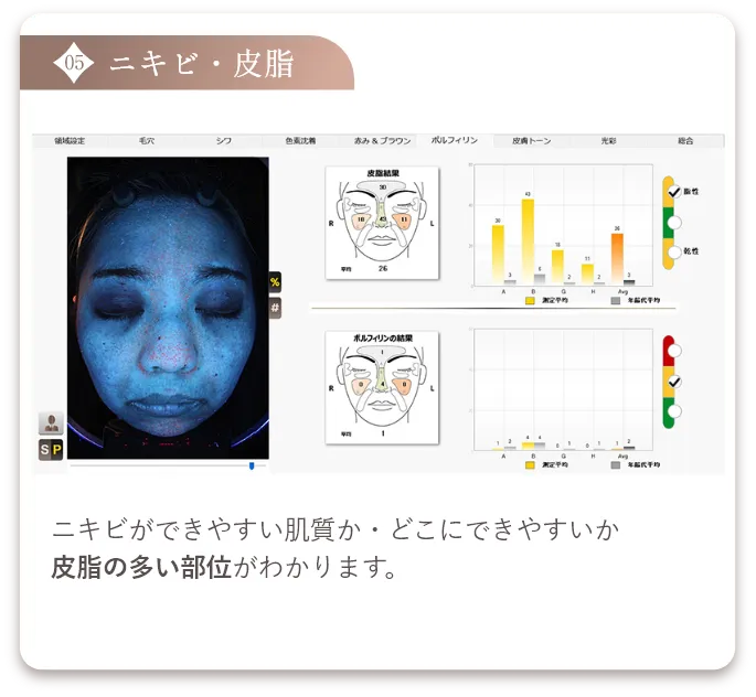 ニキビ・皮脂