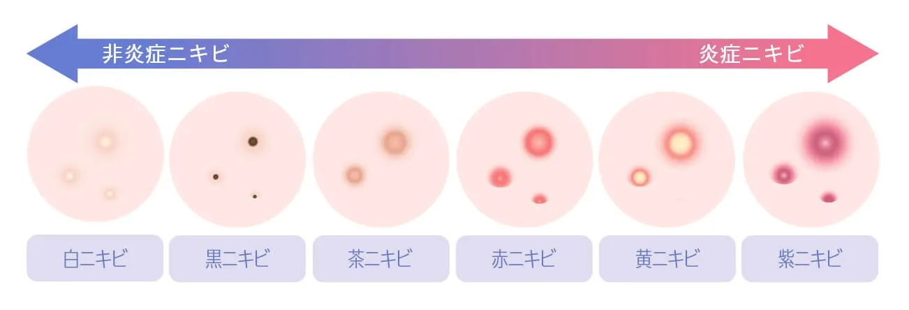お悩みニキビの種類画像