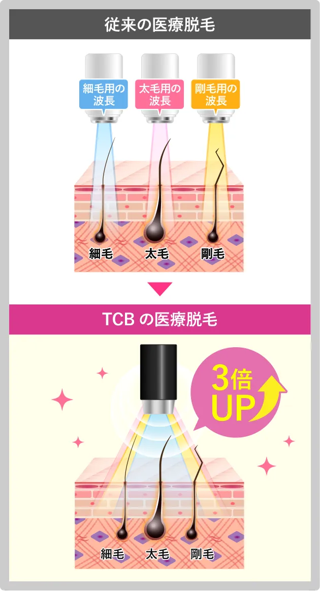 TCBの医療脱毛