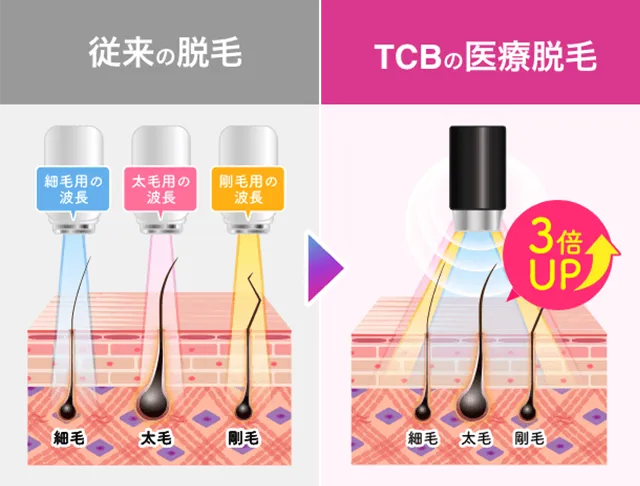 従来の脱毛とTCBの医療脱毛