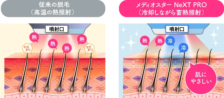 メディオスター NeXT PRO（冷却しながら蓄熱照射）