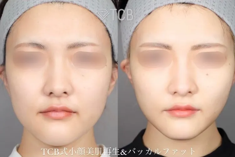 糸フェイスリフトの症例写真