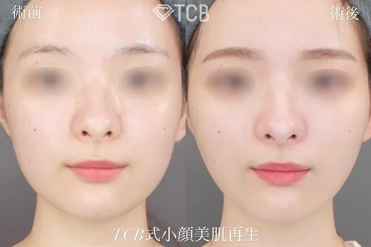 糸フェイスリフトの症例写真