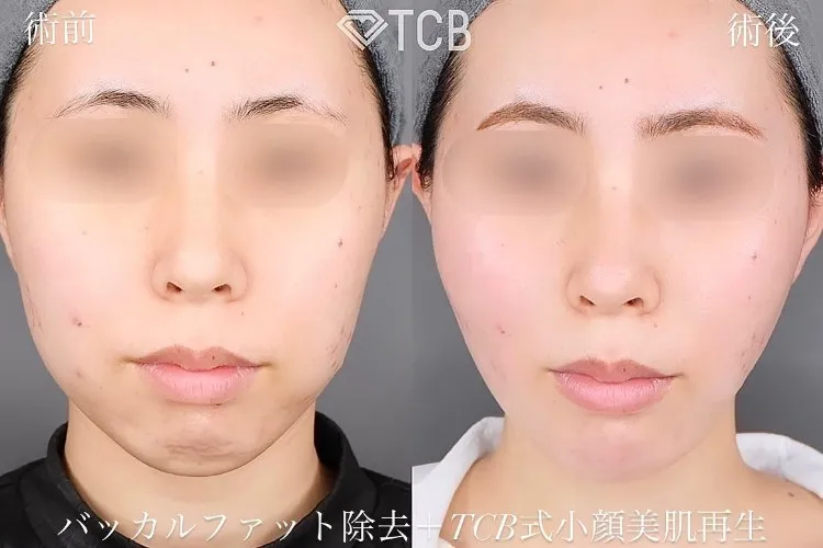 糸フェイスリフトの症例写真