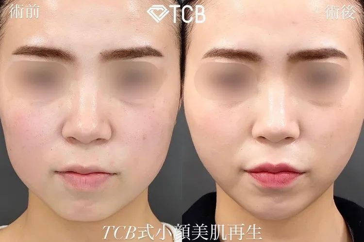 糸フェイスリフトの症例写真