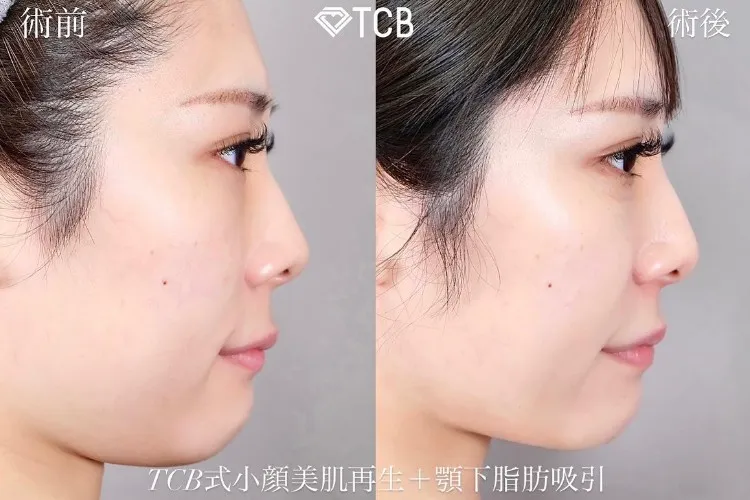 糸フェイスリフトの症例写真
