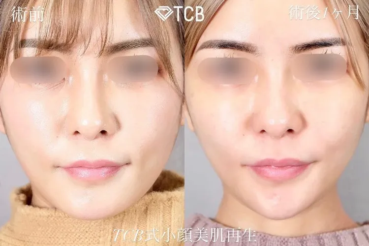 糸フェイスリフトの症例写真