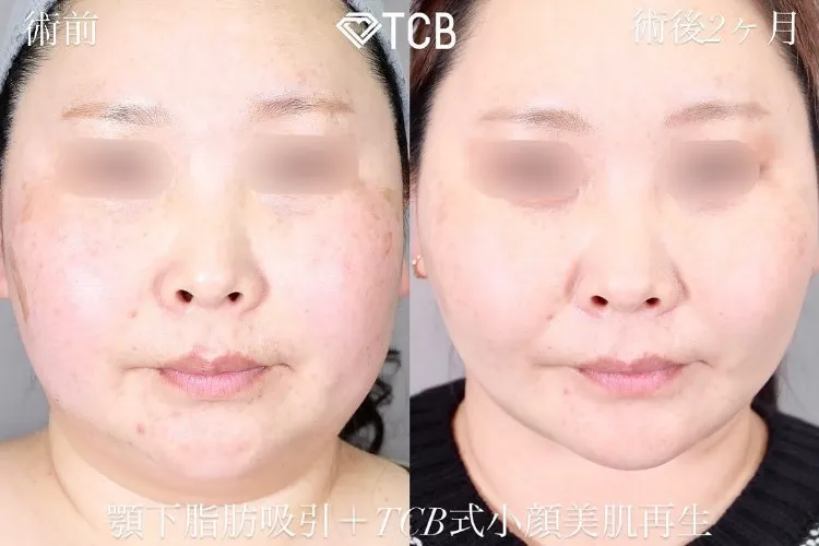糸フェイスリフトの症例写真