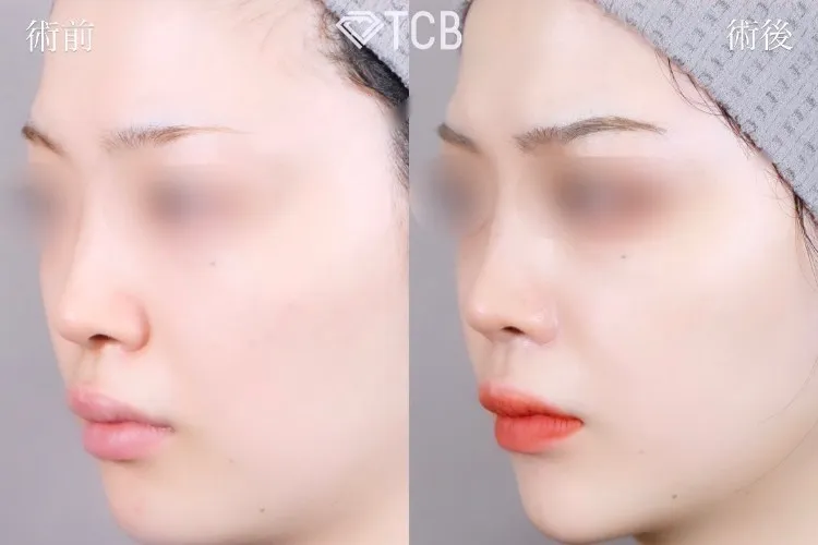 糸フェイスリフトの症例写真