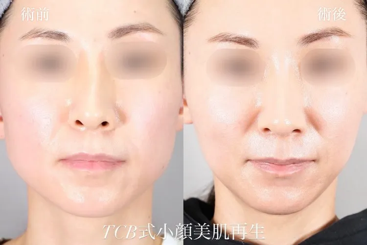 糸フェイスリフトの症例写真