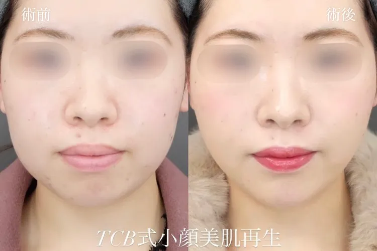 糸フェイスリフトの症例写真