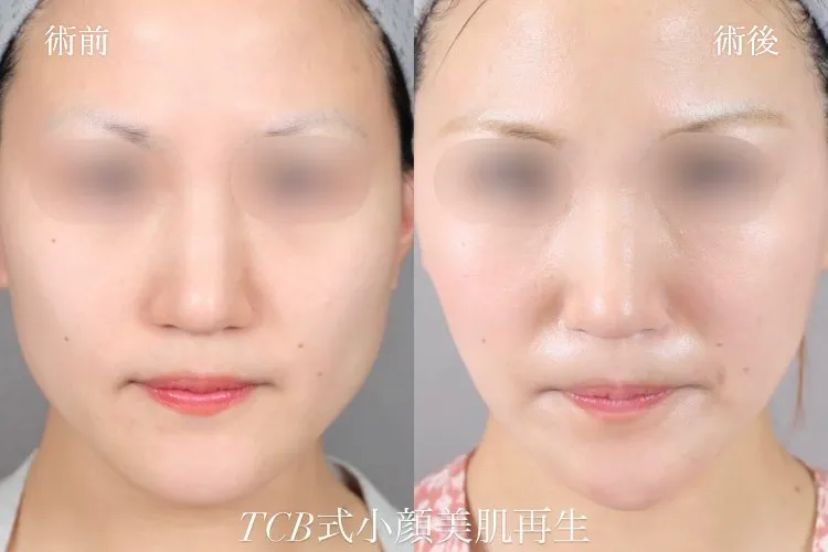 糸フェイスリフトの症例写真