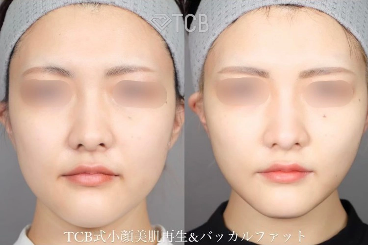 糸フェイスリフトの症例写真