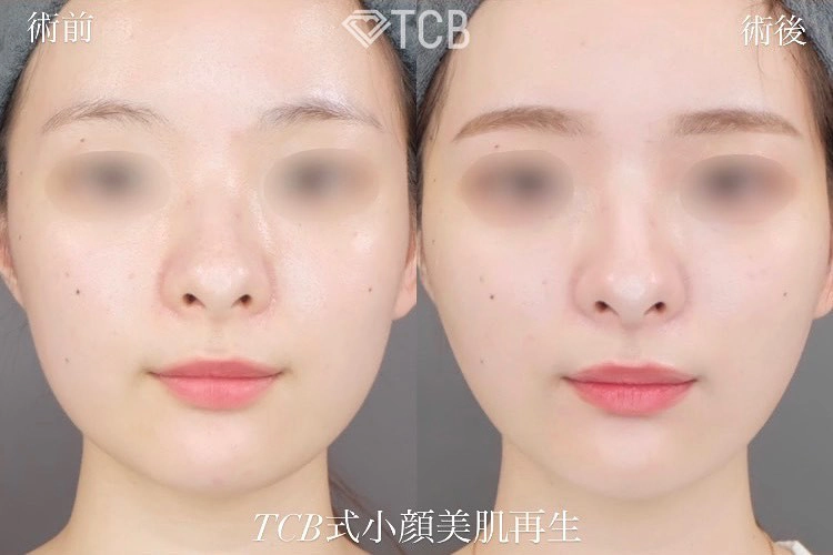 糸フェイスリフトの症例写真
