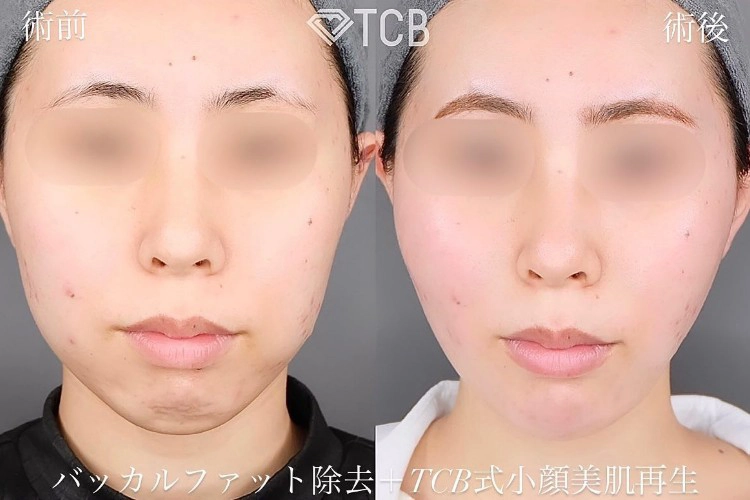 糸フェイスリフトの症例写真
