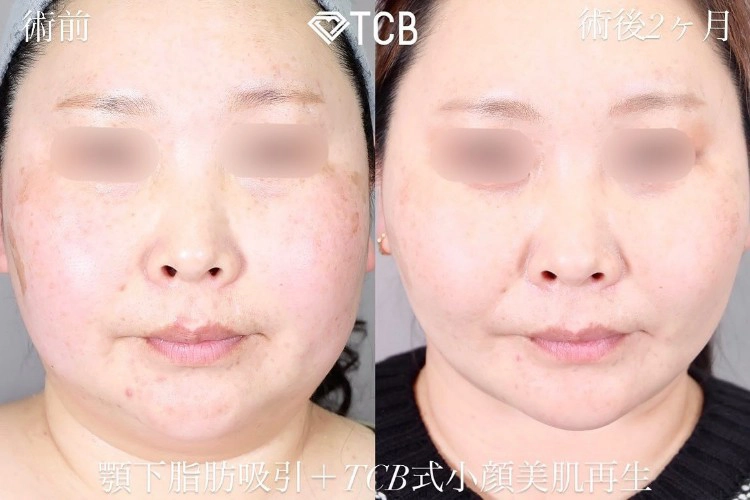 糸フェイスリフトの症例写真