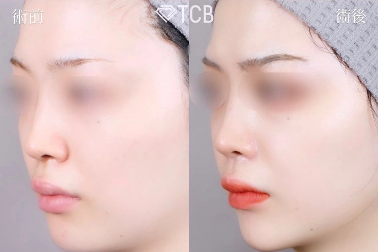 糸フェイスリフトの症例写真